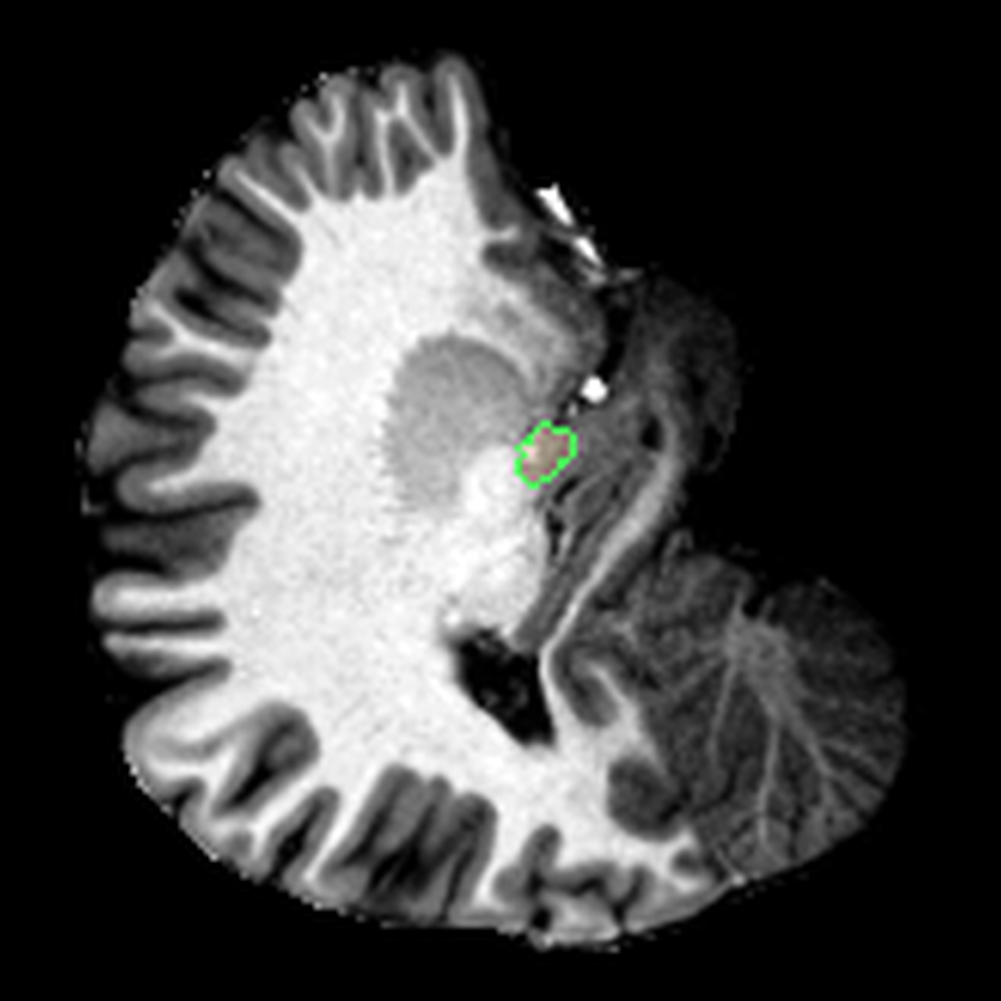FreeSurfer-based snapshot of the left amygdala.