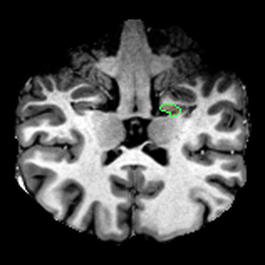 FreeSurfer-based snapshot of the left hippocampus.