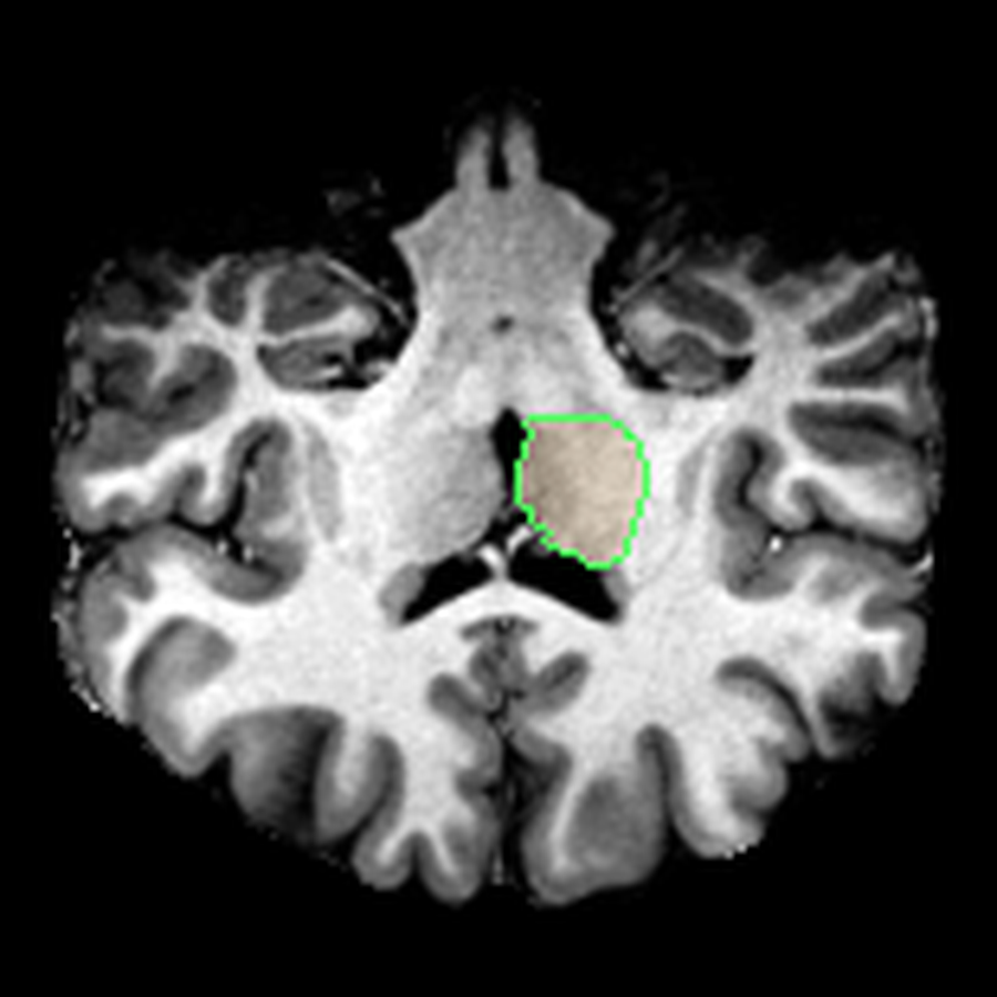 FreeSurfer-based snapshot of the left thalamus.
