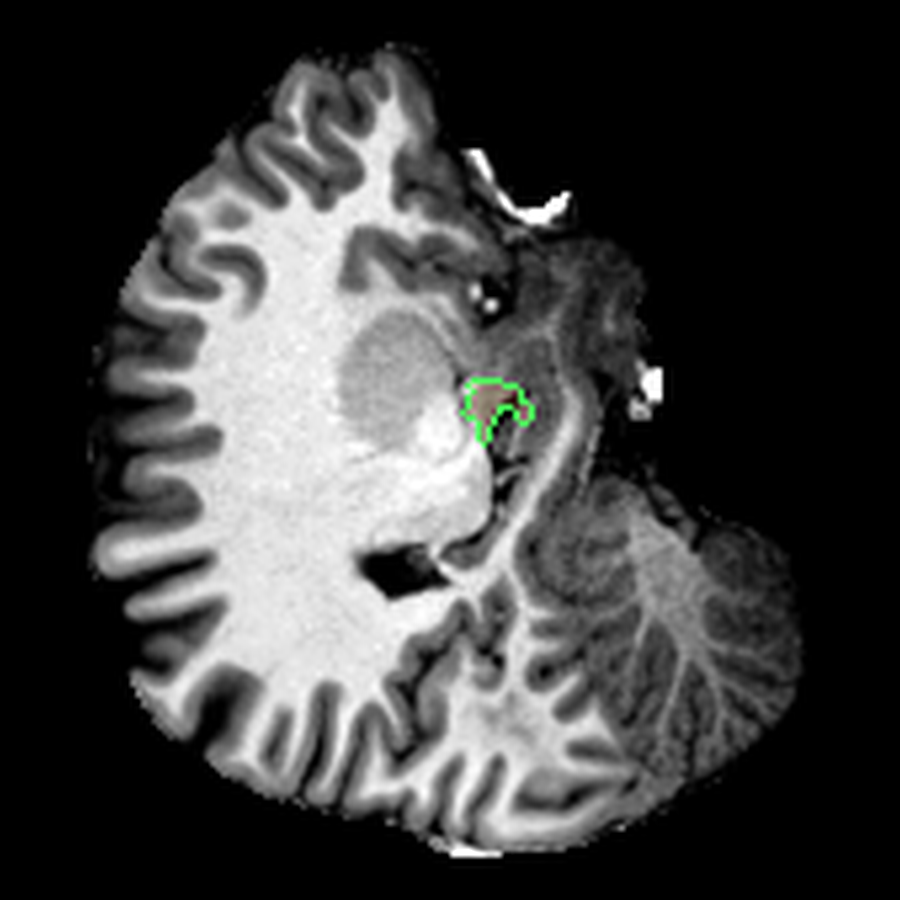 FreeSurfer-based snapshot of the right amygdala.