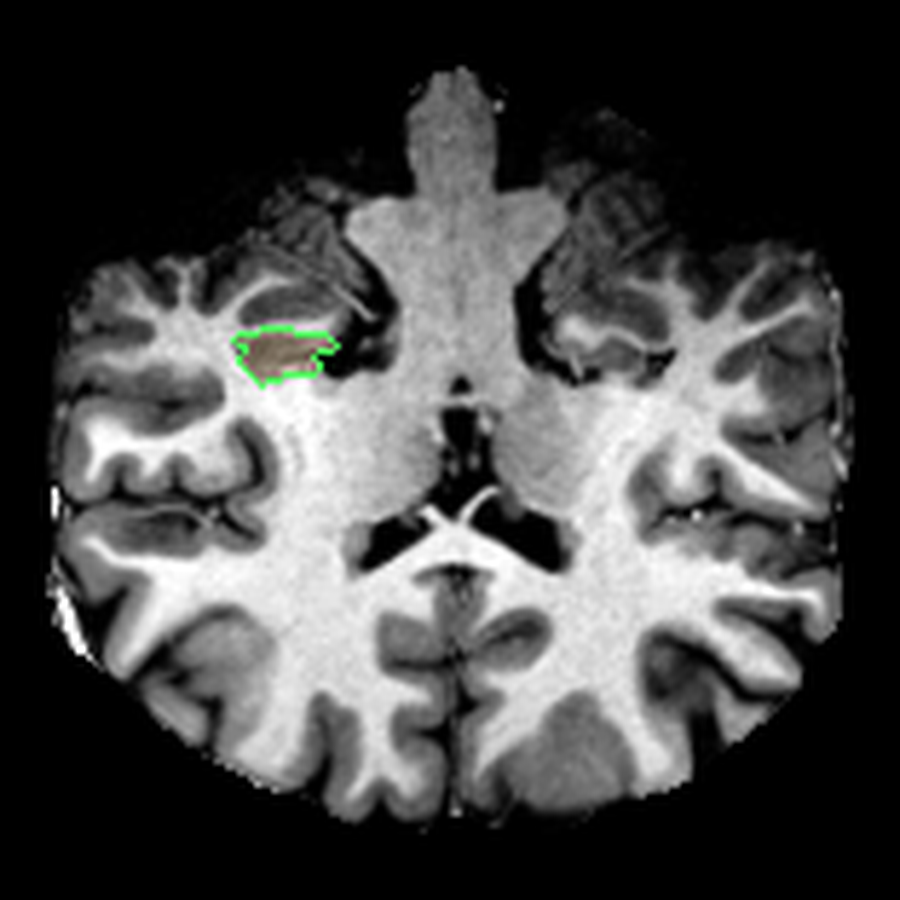 FreeSurfer-based snapshot of the right hippocampus.