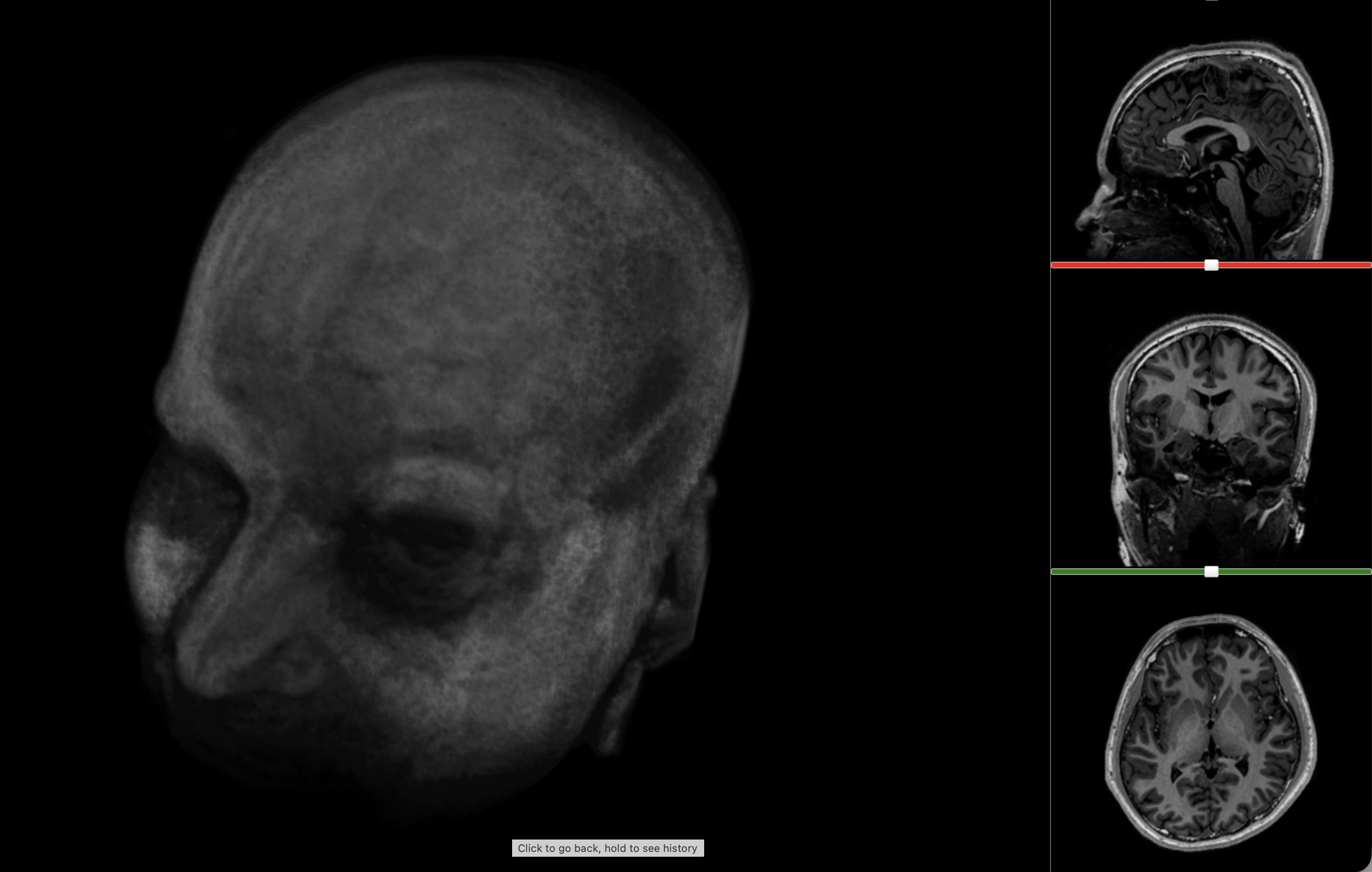Point-cloud style 3D MRI view showing the skull more clearly than the brain.