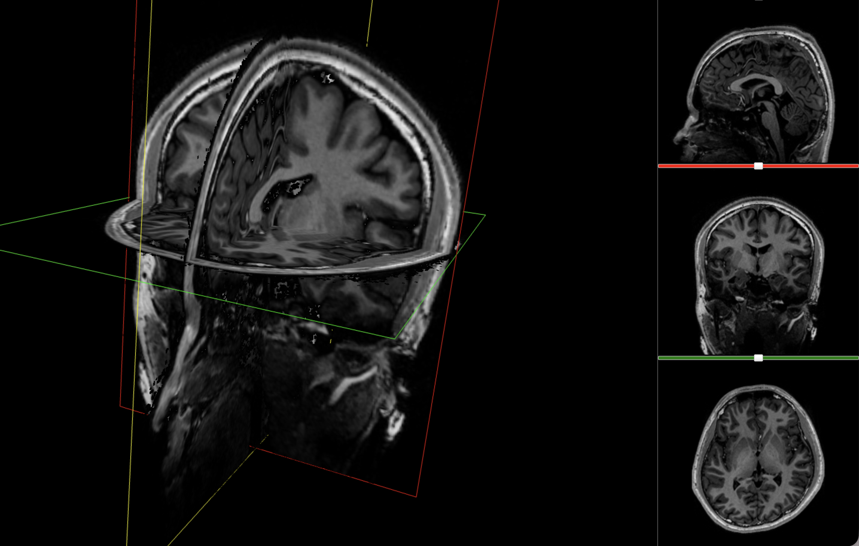 MRI viewer showing aligned axial, coronal and sagittal views.